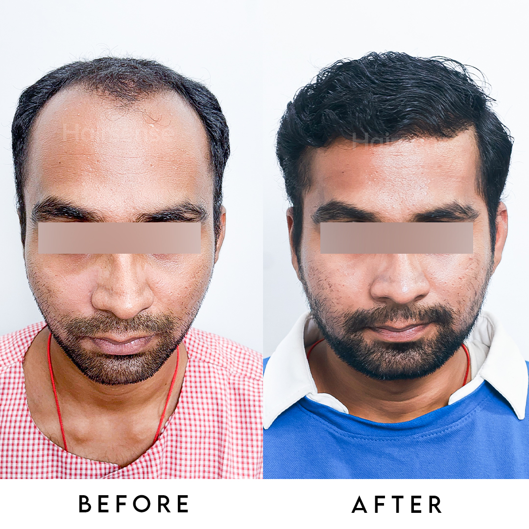 High density hair transplant result DSHI technique HairSense